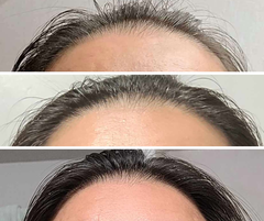 before and after treatment photo