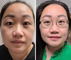before and after treatment image